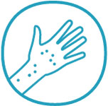 Gürtelrose Symptome, einseitiger brennender oder stechender Schmerz, Hautrötungen am Arm